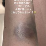 【女優】田中道子、「ドライヤー爆発」でやけど…黒ずんだ腕の写真公開　朝一病院へ　フォロワーのアドバイスに感謝