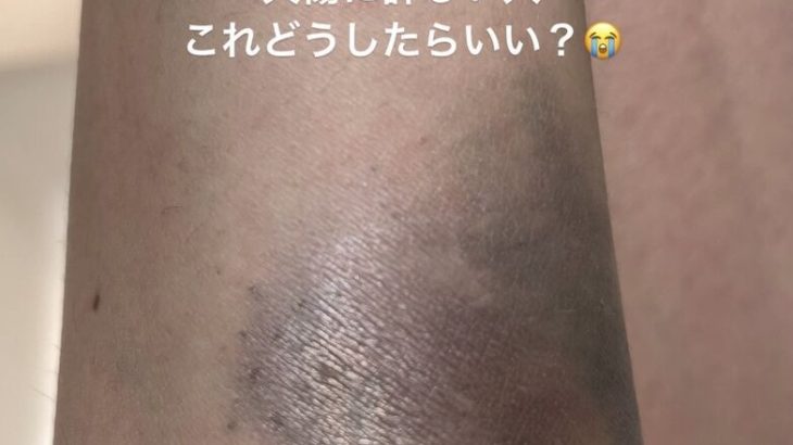 【女優】田中道子、「ドライヤー爆発」でやけど…黒ずんだ腕の写真公開　朝一病院へ　フォロワーのアドバイスに感謝